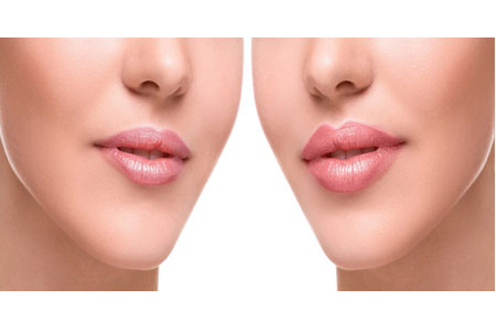 تزریق فیلر (ژل و چربی)