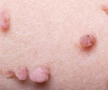 جراحی خال, زگیل و ضایعات خوش خیم