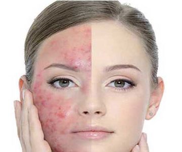 لیزرهای از بین برنده لک های ناشی از آفتاب و افزایش سن