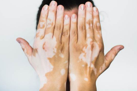 درمان جراحی ویتیلیگو (لک و پیس)